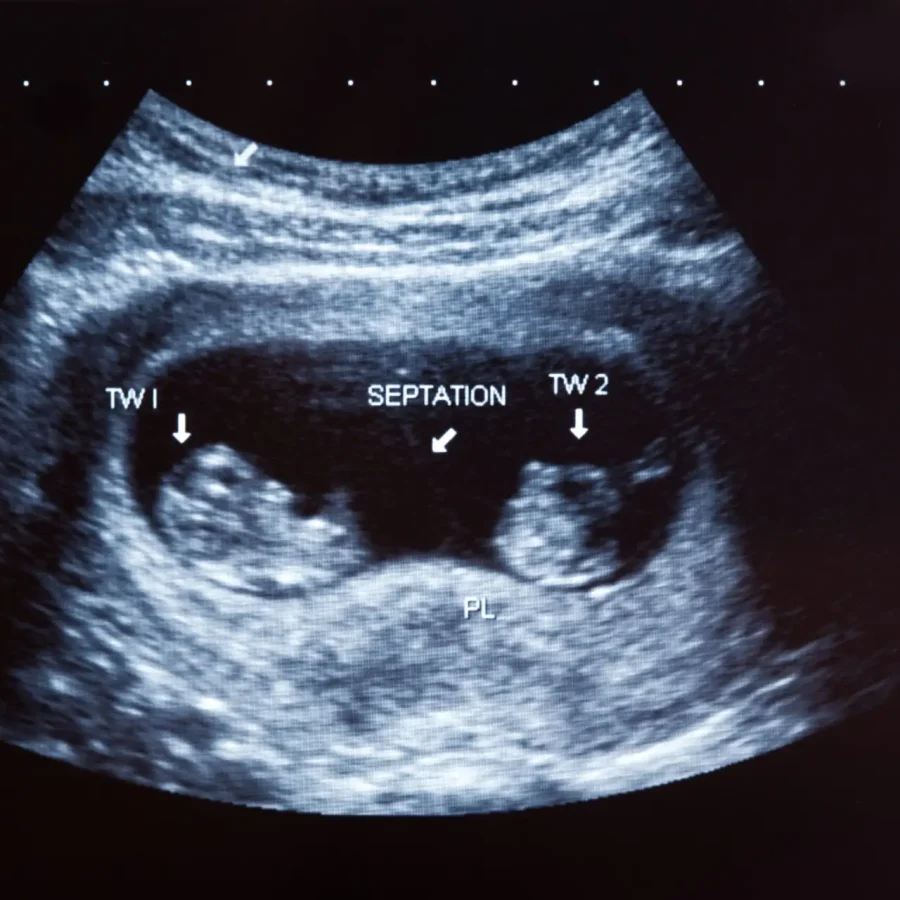 Ultrasound scan of 10 months old twin boys